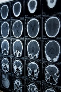 brain injury lawyer in New Brunswick, NJ